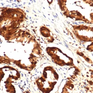 FFPE human prostate with IDH1-R132H mutation stained with IDH1-R132H Recombinant Rabbit MAb (IDH1.R132H/8205R). HIER: Tris/EDTA, pH9.0, 45min. 2°C: HRP-polymer, 30min. DAB, 5min.