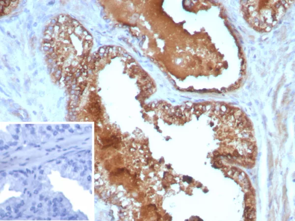 Formalin-fixed, paraffin-embedded human prostate cancer stained with IL10 Mouse Monoclonal Antibody (IL10/8711). Inset: PBS instead of primary antibody; secondary only negative control.