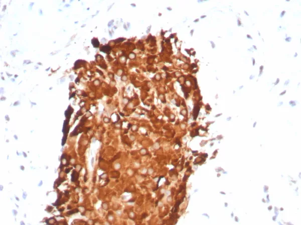 IHC analysis of formalin-fixed, paraffin-embedded human testicular carcinoma. Stained with INHA/8872R at 2ug/ml in PBS for 30min RT. HIER: Tris/EDTA, pH9.0, 45min. 2°C: HRP-polymer, 30min. DAB, 5min.