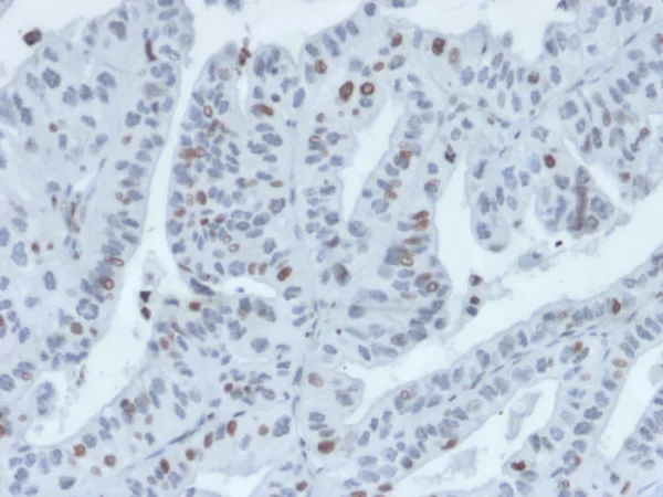 Formalin-fixed, paraffin-embedded human tumor of unknown origin stained with IRF3 Mouse Monoclonal Antibody (PCRP-IRF3-4D7).