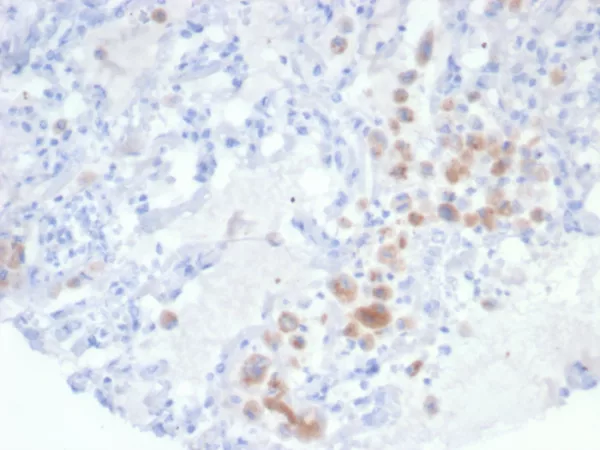 Formalin-fixed, paraffin-embedded human lung stained with IRS1 Mouse Monoclonal Antibody (IRS1/7571). HIER: Tris/EDTA, pH9.0, 45min. 2°C: HRP-polymer, 30min. DAB, 5min.