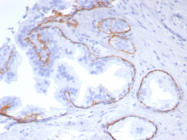 Formalin-fixed, paraffin-embedded human prostate stained with Cytokeratin 5 Recombinant Mouse Monoclonal Antibody (rKRT5/6969). HIER: Tris/EDTA, pH9.0, 45min. 2: HRP-polymer, 30min. DAB, 5min.