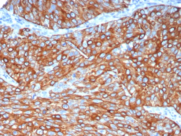 Formalin-fixed, paraffin-embedded human lung adenocarcinoma stained with Cytokeratin 6A Recombinant Rabbit Monoclonal Antibody (KRT6/8120R). HIER: Tris/EDTA, pH9.0, 45min. 2: HRP-polymer, 30min. DAB, 5min.