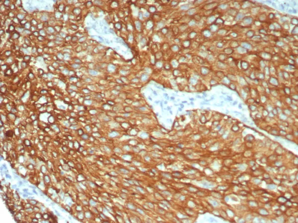 Formalin-fixed, paraffin-embedded human lung stained with Cytokeratin 6A Recombinant Rabbit Monoclonal Antibody (KRT6/8198R). HIER: Tris/EDTA, pH9.0, 45min. 2: HRP-polymer, 30min. DAB, 5min.