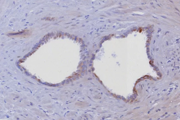 Formalin-fixed, paraffin-embedded human prostate stained with Cytokeratin 6A Recombinant Rabbit Monoclonal Antibody (KRT6/8198R). HIER: Tris/EDTA, pH9.0, 45min. 2: HRP-polymer, 30min. DAB, 5min.