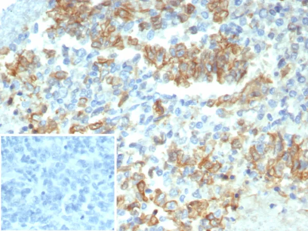 Formalin-fixed, paraffin-embedded human ovarian carcinoma stained with Cytokeratin-7 Mouse Monoclonal Antibody (KRT7/3733). Inset: PBS instead of primary antibody; secondary only negative control.