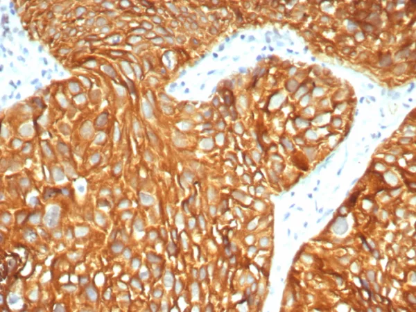 Formalin-fixed, paraffin-embedded human bladder carcinoma stained with Cytokeratin-7 Mouse Monoclonal Antibody (KRT7/3733). HIER: Tris/EDTA, pH9.0, 45min. 2°C: HRP-polymer, 30min. DAB, 5min.