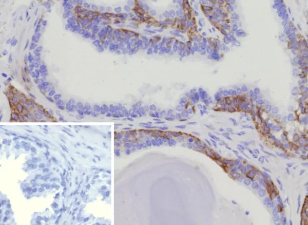 Formalin-fixed, paraffin-embedded human prostate cancer stained with  Cytokeratin 15 Rabbit Recombinant Monoclonal Antibody (KRT15/9088R). Inset: PBS instead of primary antibody; secondary only negative control.