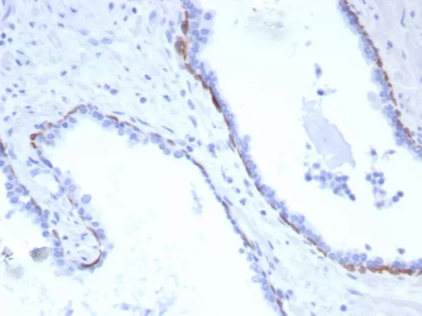 Formalin-fixed, paraffin-embedded human prostate carcinoma stained with CK17 Recombinant Rabbit Monoclonal Antibody (KRT17/8320R). HIER: Tris/EDTA, pH9.0, 45min. 2°C: HRP-polymer, 30min. DAB, 5min.