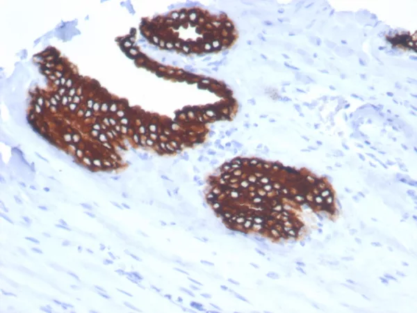 Formalin-fixed, paraffin-embedded human prostate stained with  CK18 Rabbit Recombinant Monoclonal Antibody (KRT18/7056R). HIER: Tris/EDTA, pH9.0, 45min. 2°C: HRP-polymer, 30min. DAB, 5min.