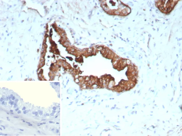 Formalin-fixed, paraffin-embedded human prostate cancer stained with Cytokeratin 19 Recombinant Mouse Monoclonal Antibody (rKRT19/9108). HIER: Tris/EDTA, pH9.0, 45min. 2°C: HRP-polymer, 30min. DAB, 5min.