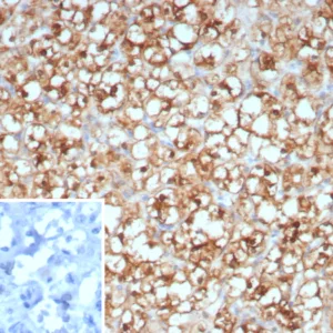 Formalin-fixed, paraffin-embedded human renal cell carcinoma stained with Stathmin 1 Mouse Monoclonal Antibody (STMN1/8438). Inset: PBS instead of primary antibody; secondary only negative control.