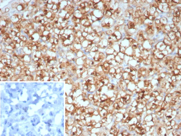 Formalin-fixed, paraffin-embedded human renal cell carcinoma stained with Stathmin 1 Mouse Monoclonal Antibody (STMN1/8438). Inset: PBS instead of primary antibody; secondary only negative control.