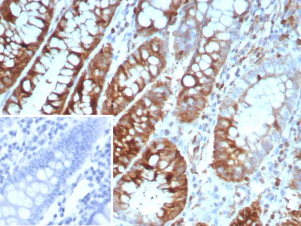 Formalin-fixed, paraffin-embedded human colon carcinoma stained with Stathmin 1 Mouse Monoclonal Antibody (STMN1/8439). Inset: PBS instead of primary antibody; secondary only negative control.