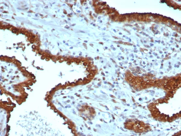 Formalin-fixed, paraffin-embedded human prostate stained with Galectin-3 Mouse Monoclonal Antibody (LGALS3/6583). HIER: Tris/EDTA, pH9.0, 45min. 2°C: HRP-polymer, 30min. DAB, 5min.