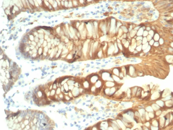 Formalin-fixed, paraffin-embedded human colon stained with Galectin-3 Recombinant Mouse Monoclonal Antibody (rLGALS3/7286). HIER: Tris/EDTA, pH9.0, 45min. 2°C: HRP-polymer, 30min. DAB, 5min.