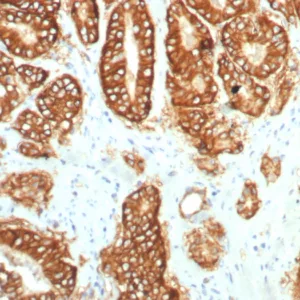 Formalin-fixed, paraffin-embedded human prostate carcinoma stained with TACSTD2 Recombinant Rabbit Monoclonal Antibody (TACSTD2/7349R). HIER: Tris/EDTA, pH9.0, 45min. 2°C: HRP-polymer, 30min. DAB, 5min.