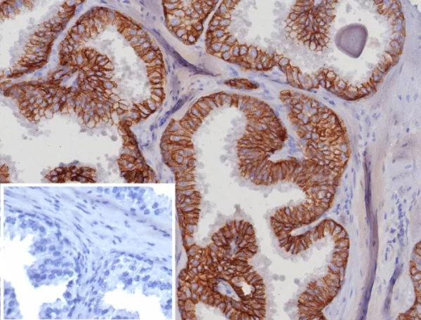 IHC analysis of formalin-fixed, paraffin-embedded human prostate carcinoma. EpCAM Rabbit Recombinant Monoclonal Antibody (EGP40/8191R). Inset: PBS instead of primary antibody; secondary only negative control.
