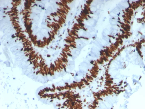 Formalin-fixed, paraffin-embedded human colon carcinoma stained with MCM3 Mouse Monoclonal Antibody (MCM3/3221). HIER: Tris/EDTA, pH9.0, 45min. 2°C: HRP-polymer, 30min. DAB, 5min.