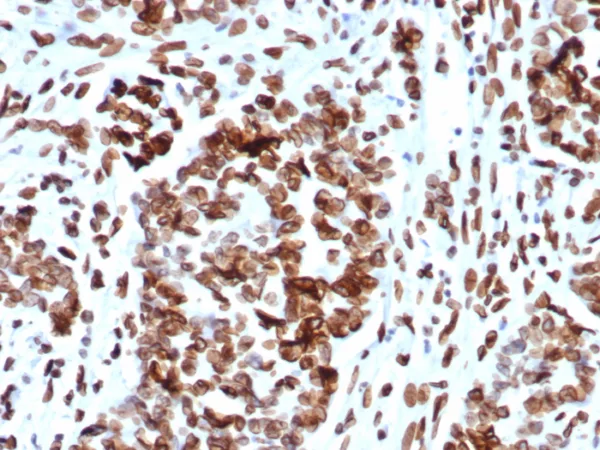 Formalin-fixed, paraffin-embedded human ovarian cancer stained with MDM2 Mouse Monoclonal Antibody (MDM2/7942). HIER: Tris/EDTA, pH9.0, 45min. 2°C: HRP-polymer, 30min. DAB, 5min.