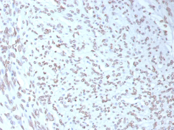 Formalin-fixed, paraffin-embedded human liposarcoma stained with MDM2 Mouse Monoclonal Antibody (MDM2/7943). HIER: Tris/EDTA, pH9.0, 45min. 2°C: HRP-polymer, 30min. DAB, 5min.