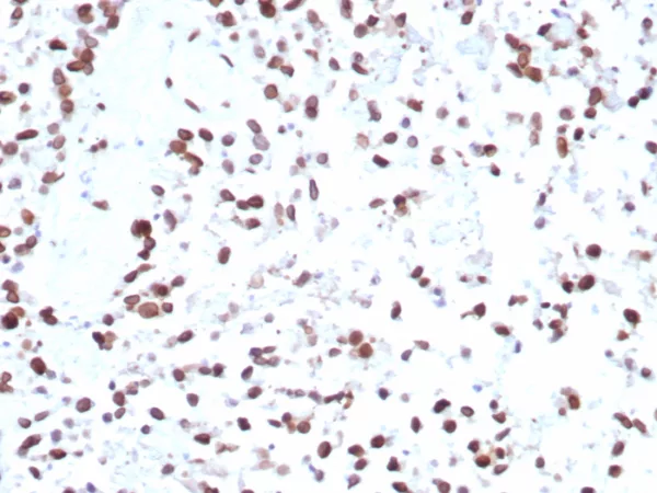 Formalin-fixed, paraffin-embedded human bladder stained with MDM2 Mouse Monoclonal Antibody (MDM2/7943). HIER: Tris/EDTA, pH9.0, 45min. 2°C: HRP-polymer, 30min. DAB, 5min.