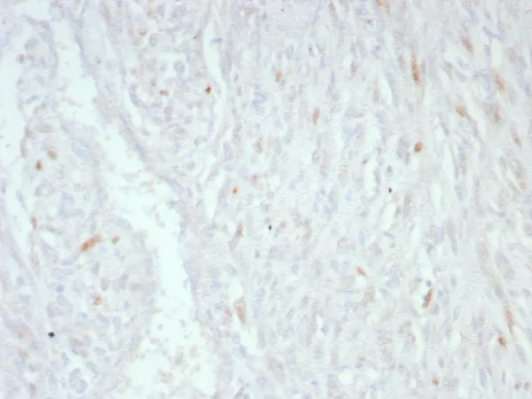 Formalin-fixed, paraffin-embedded human liposarcoma stained with MDM2 Mouse Monoclonal Antibody (MDM2/8221). HIER: Tris/EDTA, pH9.0, 45min. 2°C: HRP-polymer, 30min. DAB, 5min.