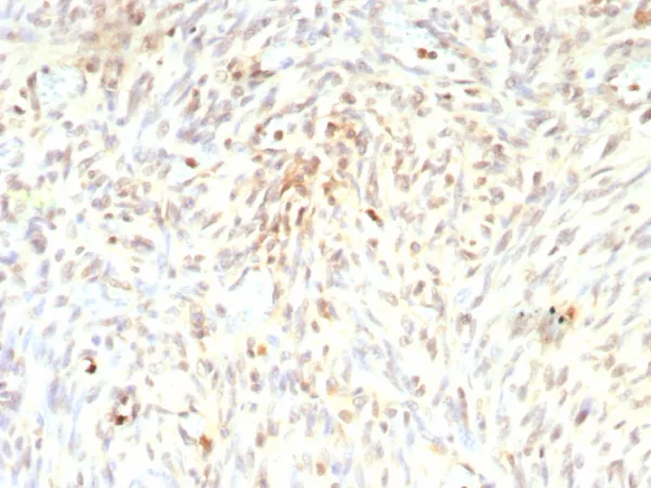 Formalin-fixed, paraffin-embedded human liposarcoma stained with MDM2 Recombinant Mouse Monoclonal Antibody (rMDM2/9214). HIER: Tris/EDTA, pH9.0, 45min. 2°C: HRP-polymer, 30min. DAB, 5min.