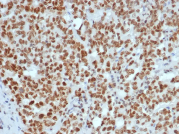 Formalin-fixed, paraffin-embedded human Lynch disease colon stained with MLH1 Mouse Monoclonal Antibody (MLH1/7560). HIER: Tris/EDTA, pH9.0, 45min. 2°C: HRP-polymer, 30min. DAB, 5min.