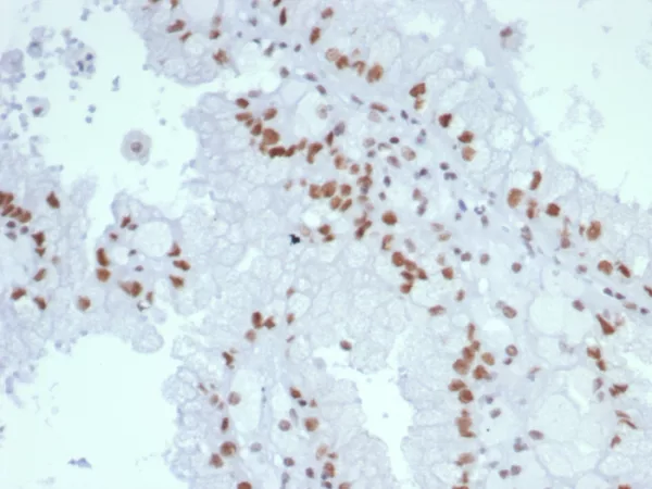 Formalin-fixed, paraffin-embedded human renal cell carcinoma stained with MLH1 Mouse Monoclonal Antibody (MLH1/7560). HIER: Tris/EDTA, pH9.0, 45min. 2°C: HRP-polymer, 30min. DAB, 5min.