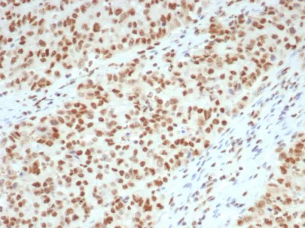 Formalin-fixed, paraffin-embedded human colon with Lynch disease stained with MLH1 Mouse Monoclonal Antibody (MLH1/7562). HIER: Tris/EDTA, pH9.0, 45min. 2°C: HRP-polymer, 30min. DAB, 5min.