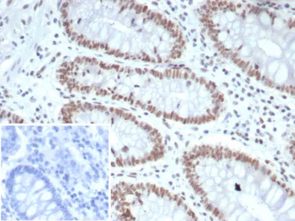 Formalin-fixed, paraffin-embedded human colon stained with MLH1 Mouse Monoclonal Antibody (MLH1/7562). HIER: Tris/EDTA, pH9.0, 45min. 2°C: HRP-polymer, 30min. DAB, 5min.