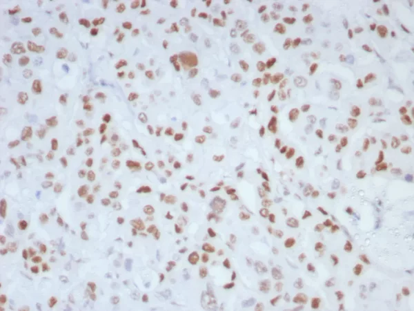 Formalin-fixed, paraffin-embedded human colon stained with MLH1 Recombinant Rabbit Monoclonal (MLH1/8855R).  HIER: Tris/EDTA, pH9.0, 45min. 2°C: HRP-polymer, 30min. DAB, 5min.