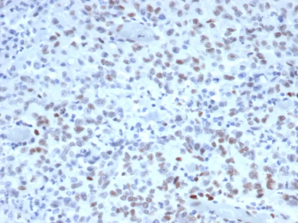 Formalin-fixed, paraffin-embedded human Lynch disease colon stained with MSH2 Mouse Monoclonal Antibody (MSH2/3165). HIER: Tris/EDTA, pH9.0, 45min. 2°C: HRP-polymer, 30min. DAB, 5min.