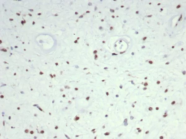 Formalin-fixed, paraffin-embedded human rhabdomyosarcoma stained with MyoD1 Mouse Monoclonal Antibody (MYOD1/7149). HIER: Tris/EDTA, pH9.0, 45min. 2°C: HRP-polymer, 30min. DAB, 5min.