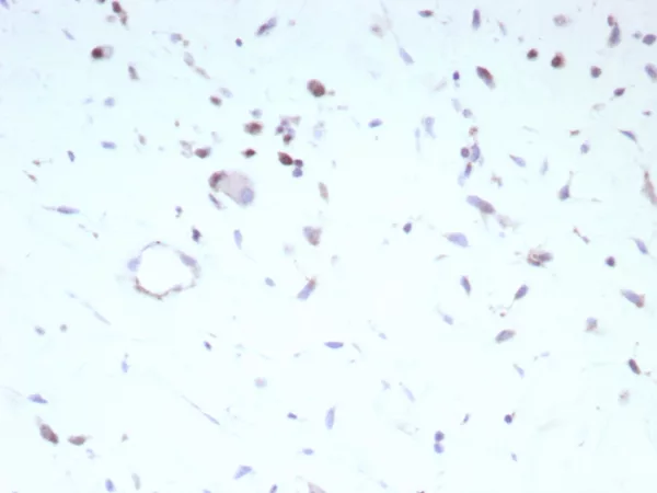 Formalin-fixed, paraffin-embedded human rhabdomyosarcoma stained with MyoD1 Recombinant Rabbit Monoclonal Antibody (MYOD1/9405R). HIER: Tris/EDTA pH9.0; 95°C/45min. 2°CAb: HRP-Poly:30min. DAB:5min.