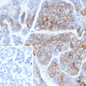 Formalin-fixed, paraffin-embedded human ovarian cancer stained with CD56 Mouse Monoclonal Antibody (NCAM1/6715). Inset: PBS instead of primary antibody; secondary only negative control.