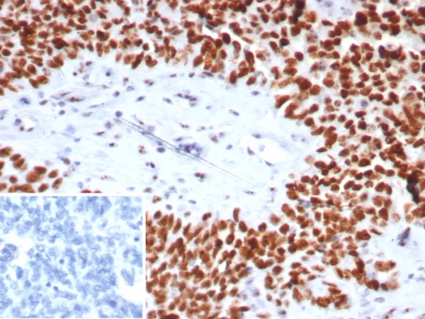 Formalin-fixed, paraffin-embedded human ovarian cancer stained with Nucleolin Mouse Monoclonal Antibody (NCL/7743). HIER: Tris/EDTA, pH9.0, 45min. 2°C: HRP-polymer, 30min. DAB, 5min.