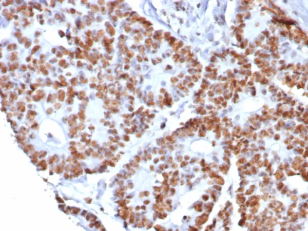 Formalin-fixed, paraffin-embedded human colon cancer stained with Nucleolin Recombinant Rabbit Monoclonal Antibody (NCL/8068R). HIER: Tris/EDTA, pH9.0, 45min. 2°C: HRP-polymer, 30min. DAB, 5min.