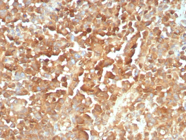 Formalin-fixed, paraffin-embedded human melanoma stained with NGFR Mouse Recombinant Monoclonal Antibody (rNGFR/8824). HIER: Tris/EDTA, pH9.0, 45min. 2°C: HRP-polymer, 30min. DAB, 5min.