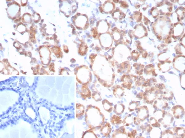 Formalin-fixed, paraffin-embedded human thyroid stained with NTRK2 / TRKb Mouse Monoclonal Antibody (NTRK2/7929). Inset: PBS instead of primary antibody; secondary only negative control.