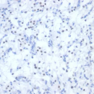 Formalin-fixed, paraffin-embedded human renal cell carcinoma stained with PAX2 Mouse Monoclonal Antibody (PAX2/2994). HIER: Tris/EDTA, pH9.0, 45min. 2°C: HRP-polymer, 30min. DAB, 5min.