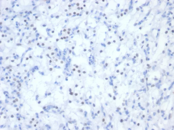 Formalin-fixed, paraffin-embedded human renal cell carcinoma stained with PAX2 Mouse Monoclonal Antibody (PAX2/2994). HIER: Tris/EDTA, pH9.0, 45min. 2°C: HRP-polymer, 30min. DAB, 5min.