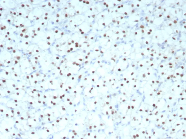 Formalin-fixed, paraffin-embedded human renal cell carcinoma stained with PAX2 Recombinant Rabbit Monoclonal Antibody (PAX2/8671R) at 2ug/ml. HIER: Tris/EDTA, pH9.0, 45min. 2°C: HRP-polymer, 30min. DAB, 5min.