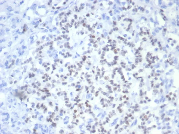 Formalin-fixed, paraffin-embedded human pancreatic cancer stained with PAX6 Mouse Monoclonal Antibody (PAX6/7708). HIER: Tris/EDTA, pH9.0, 45min. 2°C: HRP-polymer, 30min. DAB, 5min.