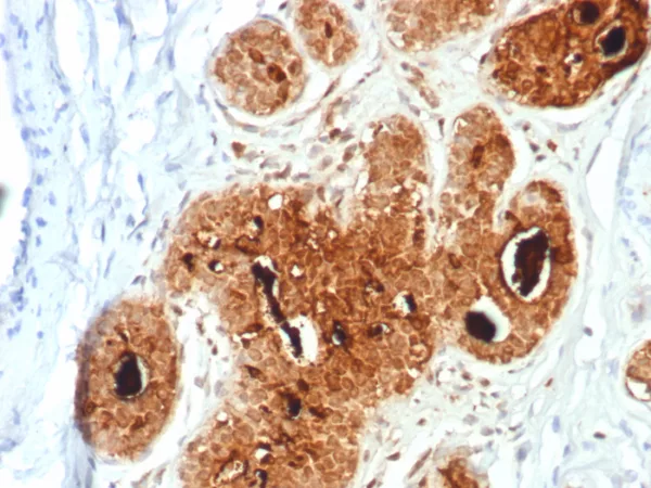 Formalin-fixed, paraffin-embedded human breast carcinoma stained with GCDFP-15 Mouse Monoclonal Antibody (PIP/7477). HIER: Tris/EDTA, pH9.0, 45min. 2°C: HRP-polymer, 30min. DAB, 5min.