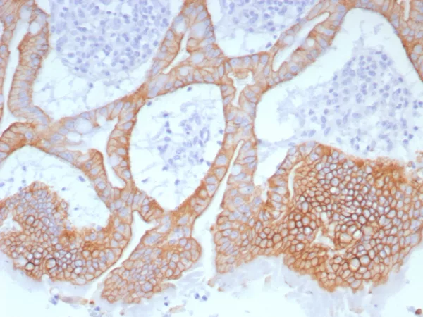 IHC analysis of formalin-fixed, paraffin-embedded human colon. CK20 Mouse Monoclonal Antibody (Ks20.8). HIER: Tris/EDTA, pH9.0, 45min. 2°C: HRP-polymer, 30min. DAB, 5min.