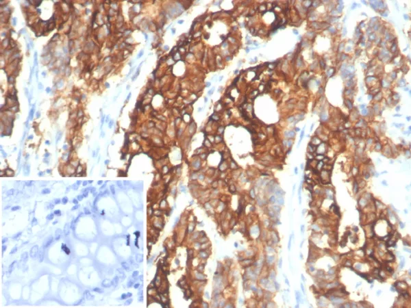 Formalin-fixed, paraffin-embedded human colon carcinoma stained with S100A14 Mouse Monoclonal Antibody (S100A14/7401). Inset: PBS instead of primary antibody; secondary only negative control.