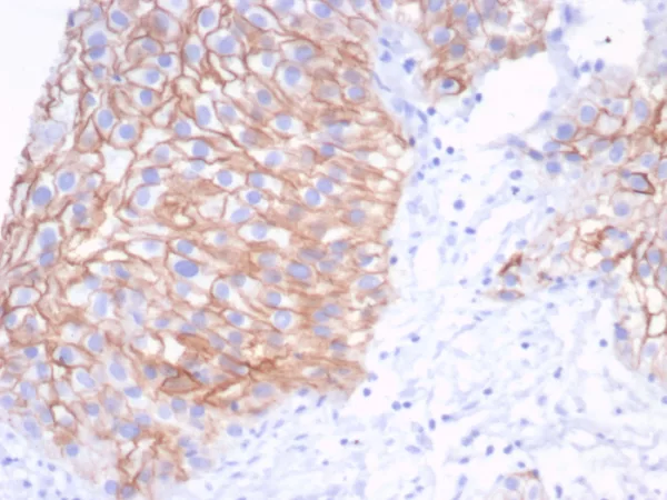 Formalin-fixed, paraffin-embedded human bladder stained with S100A14 Mouse Monoclonal Antibody (S100A14/7401). HIER: Tris/EDTA, pH9.0, 45min. 2°C: HRP-polymer, 30min. DAB, 5min.