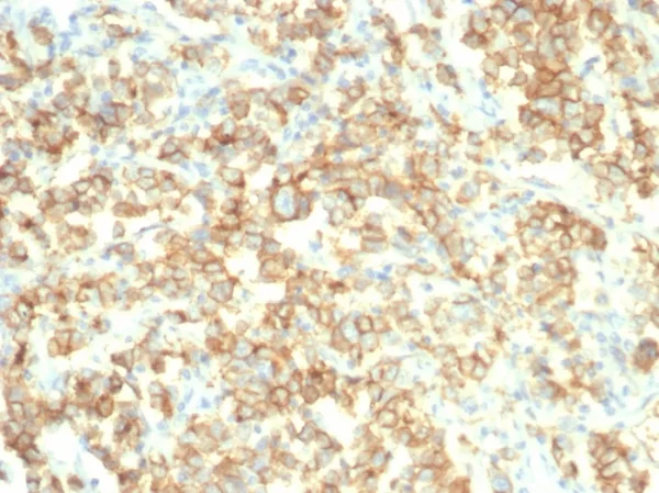 Formalin-fixed, paraffin-embedded human bladder stained with S100A14 Mouse Monoclonal Antibody (S100A14/7403). HIER: Tris/EDTA, pH9.0, 45min. 2°C: HRP-polymer, 30min. DAB, 5min.